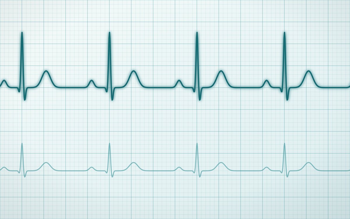 Traçado de eletrocardiograma em papel quadriculado